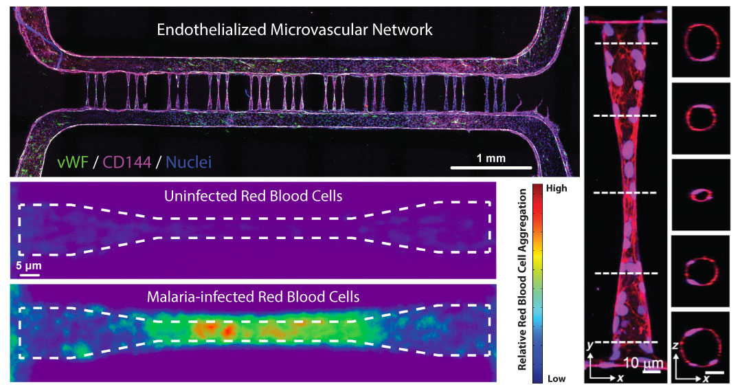 Biophysical and Biomolecular Interactions of Malaria-Infected Erythrocytes in Engineered Human Capillaries